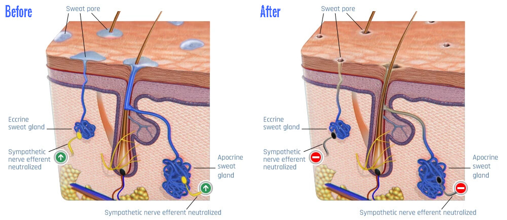 sweat glands before and after treatment