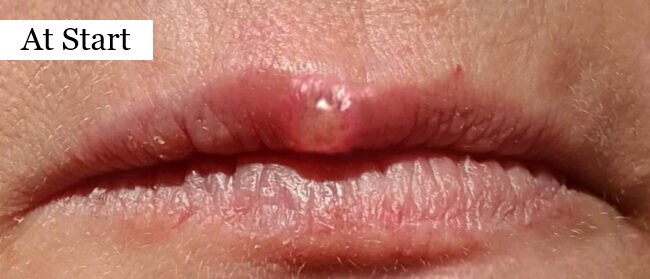 Cold sores treatment with soft laser