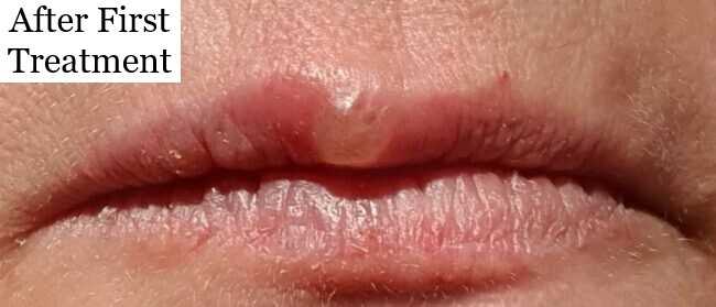 Behandlung von Lippenbläschen mit Softlaser - Schnelle Behandlung von Lippenherpes mit Softlaser