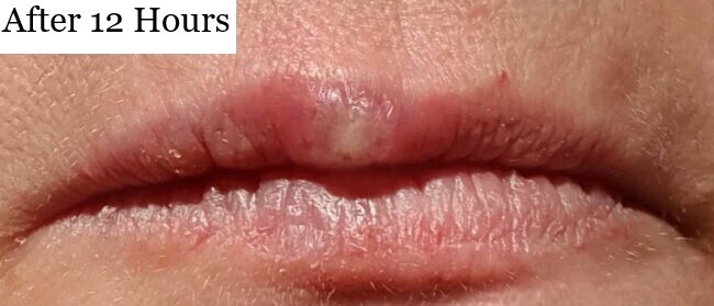 Behandlung von Lippenbläschen mit Softlaser
