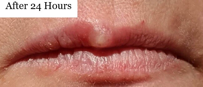 Tratamentul pentru răni reci cu laser moale - herpes la gura tratament rapid