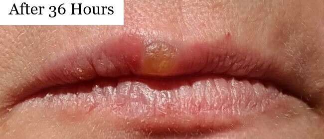 Behandlung von Lippenbläschen mit Softlaser