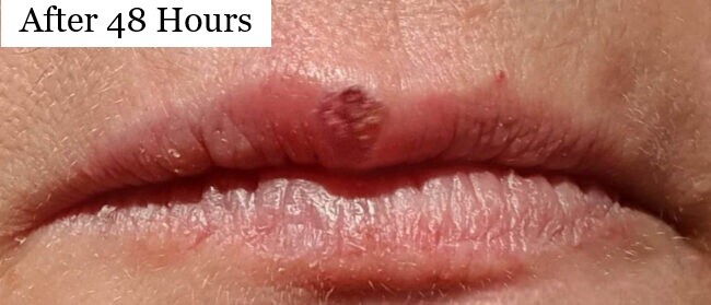 Cold sores treatment with soft laser