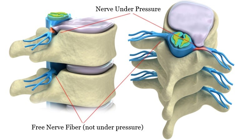 Lumbago free nerves and nerve fibers under pressure