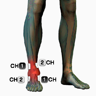 microcurrent ankle pain treatment points electrode placement