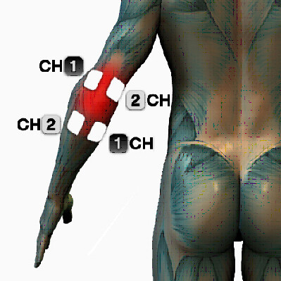 microcurrent elbow pain treatment points electrode placement