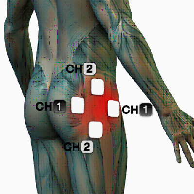 microcurrent hip pain treatment points electrode placement