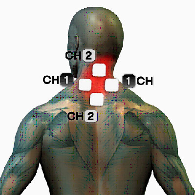microcurrent neck pain treatment points electrode placement