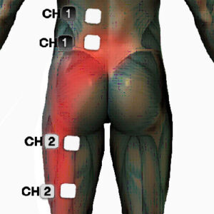 microcurrent sciatica pain treatment points electrode placement