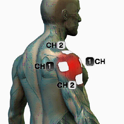 microcurrent shoulder pain treatment points electrode placement