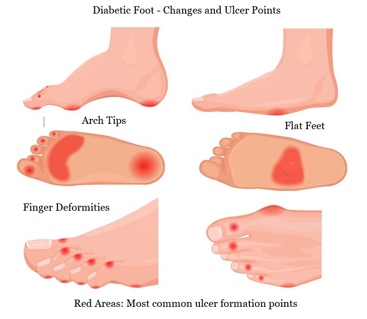 Diabetisches Bein und die häufigsten Punkte der Geschwürsbildung