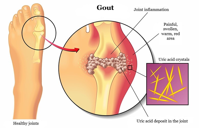 gout symptoms and treatment, gouty arthritis