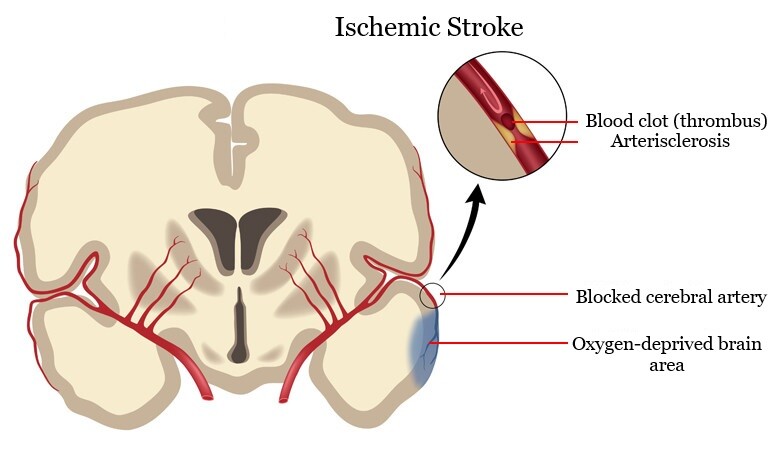 Dezvoltarea accidentului vascular cerebral ischemic