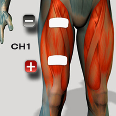 Platzierung der Muskelelektroden für den Muskelstimulator der Quads