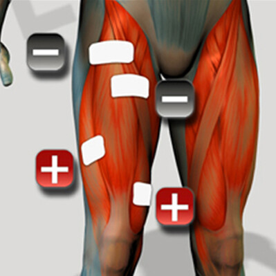 Amplasarea electrozilor pentru mușchiul Quads pentru stimulatorul muscular
