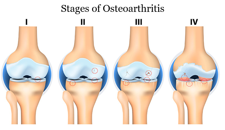 stages of osteoarthritis