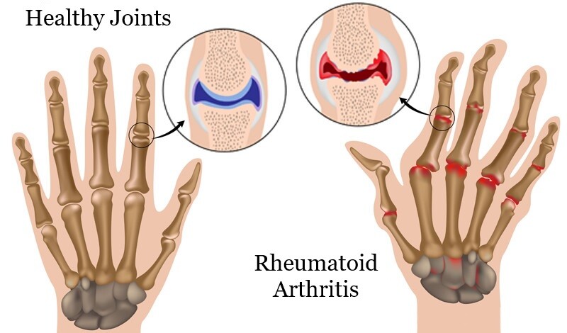 artrita reumatoida, artrita reumatoida poze, simptome