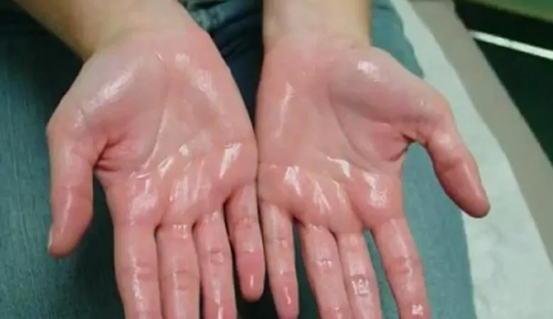 Übermäßiges Schwitzen oder Hyperhidrosis