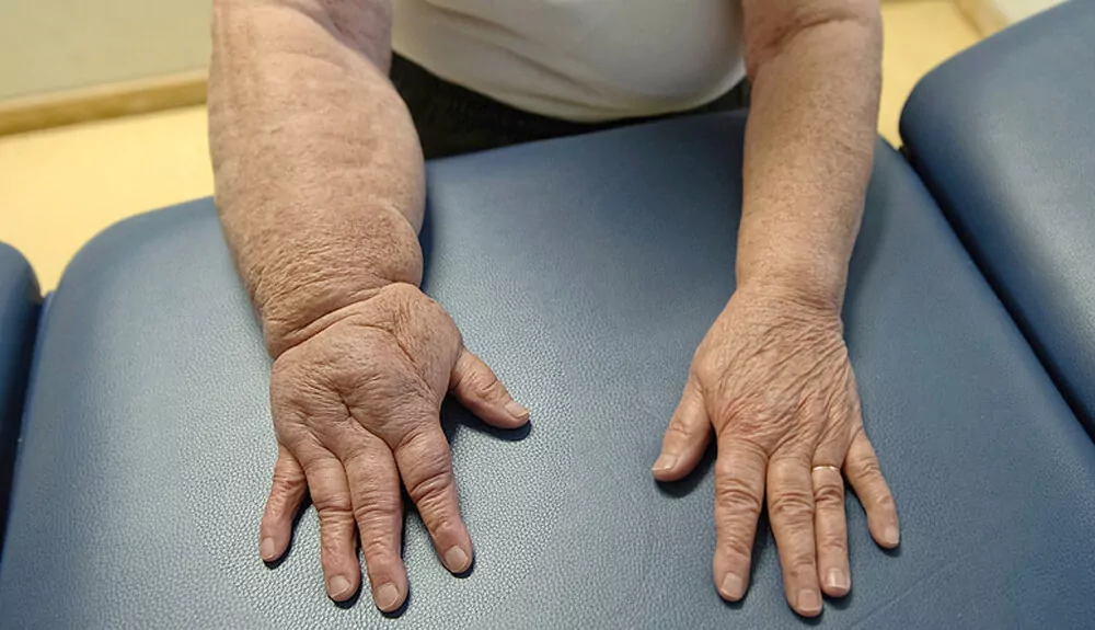 forms of lymphedema