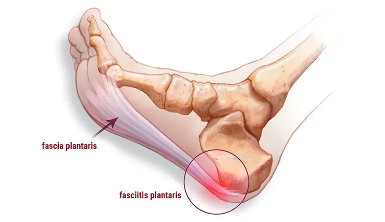 Fascia palntaris und Fasciitis plantaris