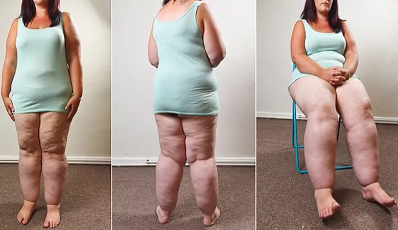 lipoedema or fat edema is a disease of women