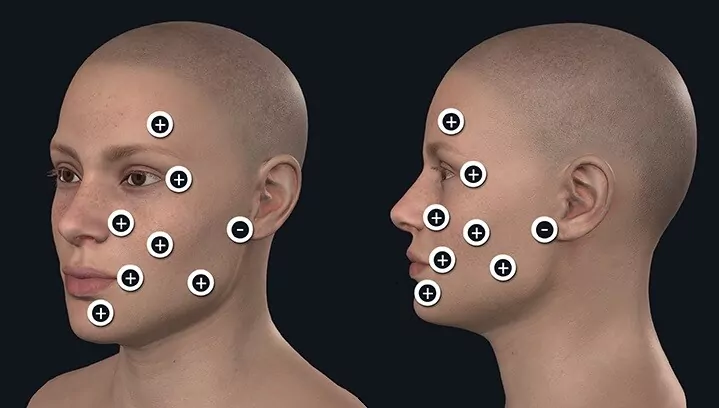 Facial paralysis treatment points with electrotherapy