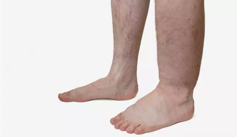 Causes of swollen feet and what to do at home