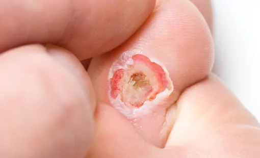 diabetic foot