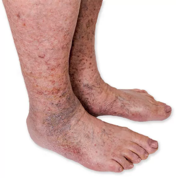 hemosiderin deposits on feet and legs