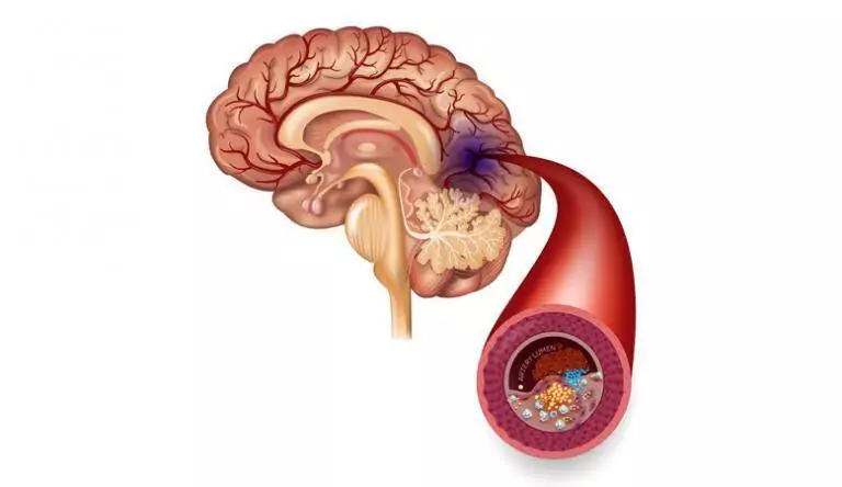 Stroke causes, symptoms and rehabilitation options